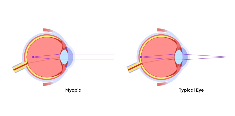 Myopia vs normal eye diagram illustrating the anatomy of a myopic eye and its vision correction needs.]