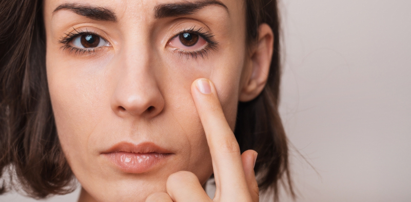 Close up of a woman pointing her finger towards her red, irritated eye
