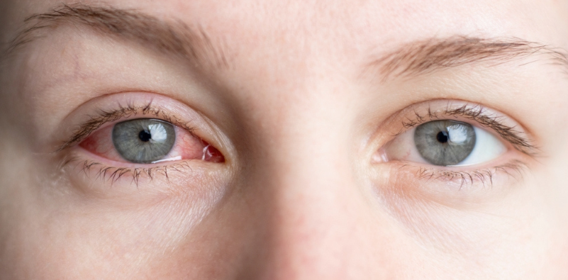 A close up of a woman’s eyes, with her right eye visibly red and irritated